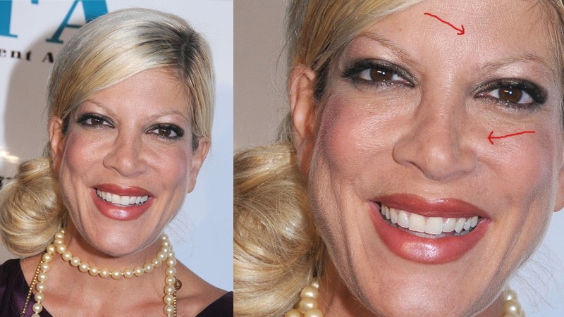 Tori Spelling wstrzykuje sobie BOTOKS