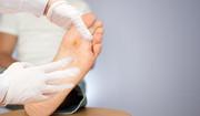 Kurzajka na stopie - przyczyny, leczenie, domowe sposoby na kurzajki na stopach