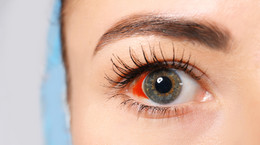 Pęknięta żyłka w oku - o czym może świadczyć? Co zrobić przy pękniętej żyłce oka?
