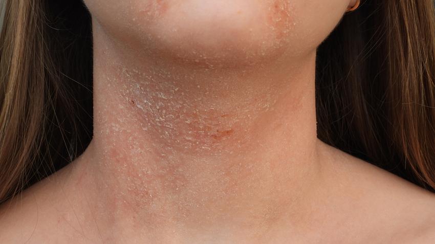 atopic dermatitis, ekcéma, hámlás, száraz bőr, krónikus betegség, bőrbetegség, bőrirritáció
