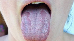 Grzybica jamy ustnej - rodzaje, przyczyny, objawy, leczenie