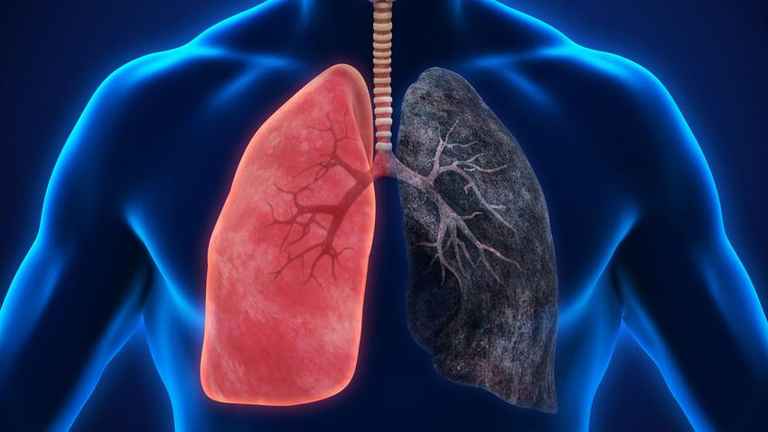COPD tüdő dohányzás cigaretta WHO