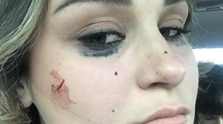 Hanna arca sérült meg a kő miatt