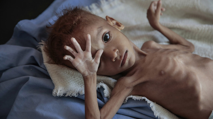Jemeni gyermekek tragédiája / MTI/AP/Hani Mohammed