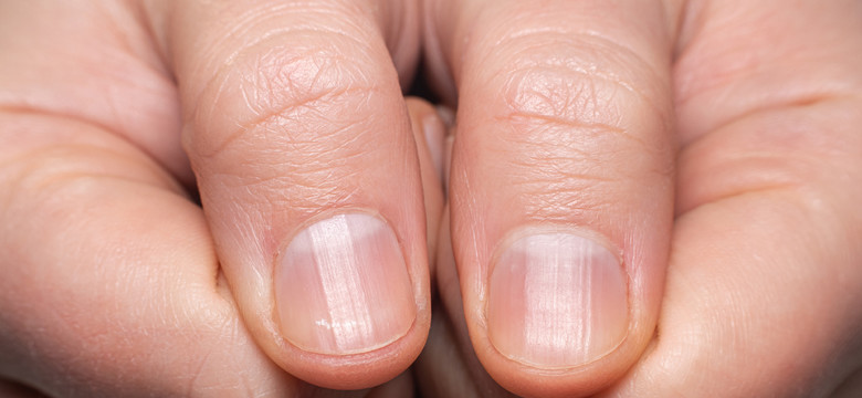 Białe półkola na paznokciach. Co mówią o naszym zdrowiu?