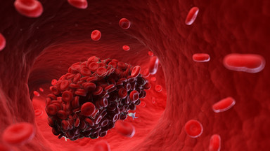 Trombofilia: nadmierna krzepliwość krwi skutkująca tworzeniem się niebezpiecznych skrzepów
