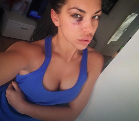 
￼
Ana Marija Žujović je početkom 2015. godine objavila fotografiju nakon prebijanja