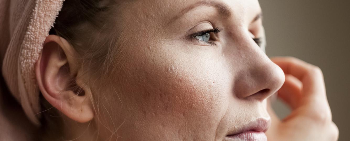 Trądzik, ciąża, choroby skóry - jak pozbyć się niechcianych blizn?
