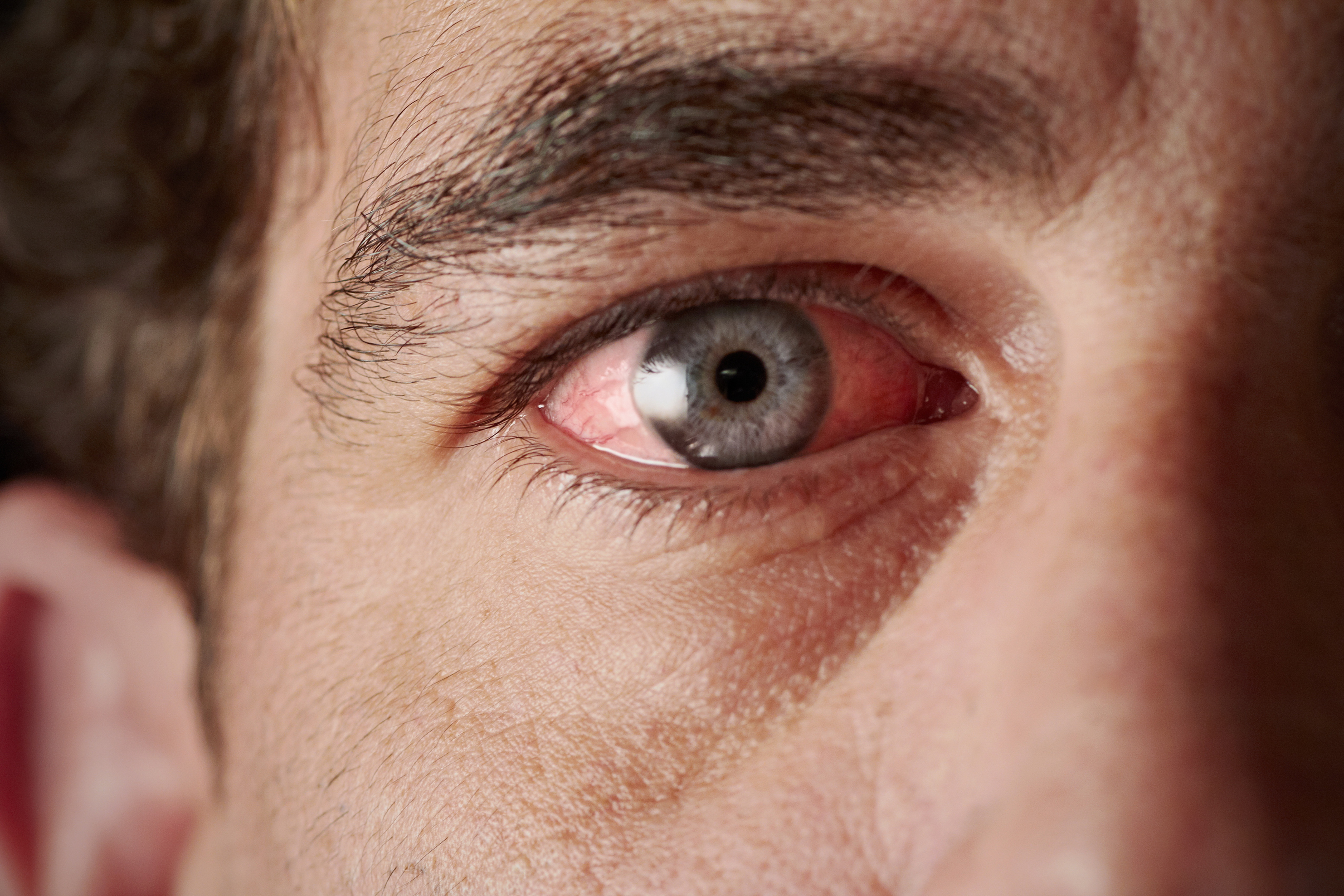 Figyeljen a jelekre - Súlyos betegségekre utalhat a véreres szem - Blikk  Rúzs