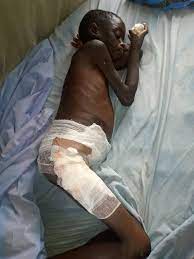 Woman burns 12-year-old daughter for misplacing GHC5 given her to buy alcohol, cigarette