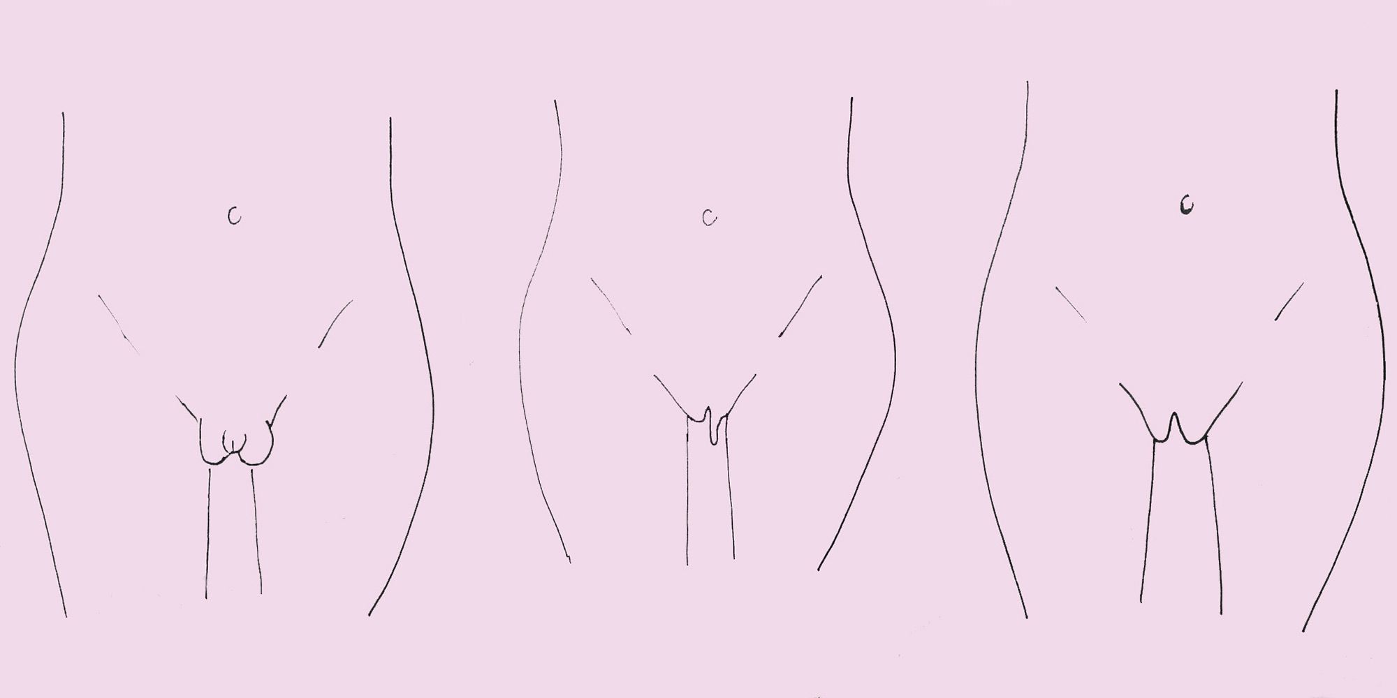 The labia majora (outer lips) are usually fleshy and covered with pubic hai...