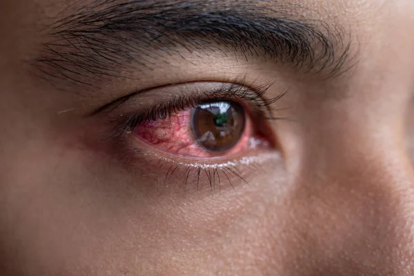Sudden red eye in the morning? Understand the reasons and find relief