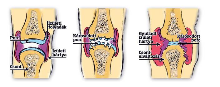 csípő és térd derékfájás váll fájdalom ideg vagy ízület
