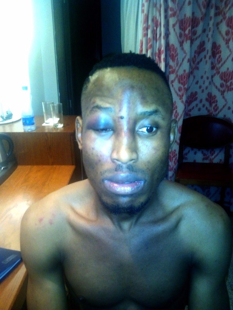 Mr 2Kay after the assault by robbers in his hotel room