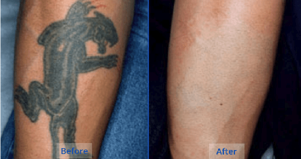 Tattoo Removal Before and After