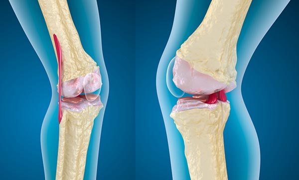 kenőcső nyaki mellkasi osteochondrosishoz ízületi fájdalom só kezelése