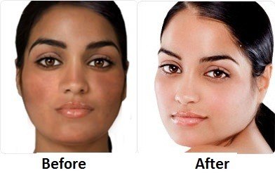 Here\'s all the ways bleaching destroys your skin and health