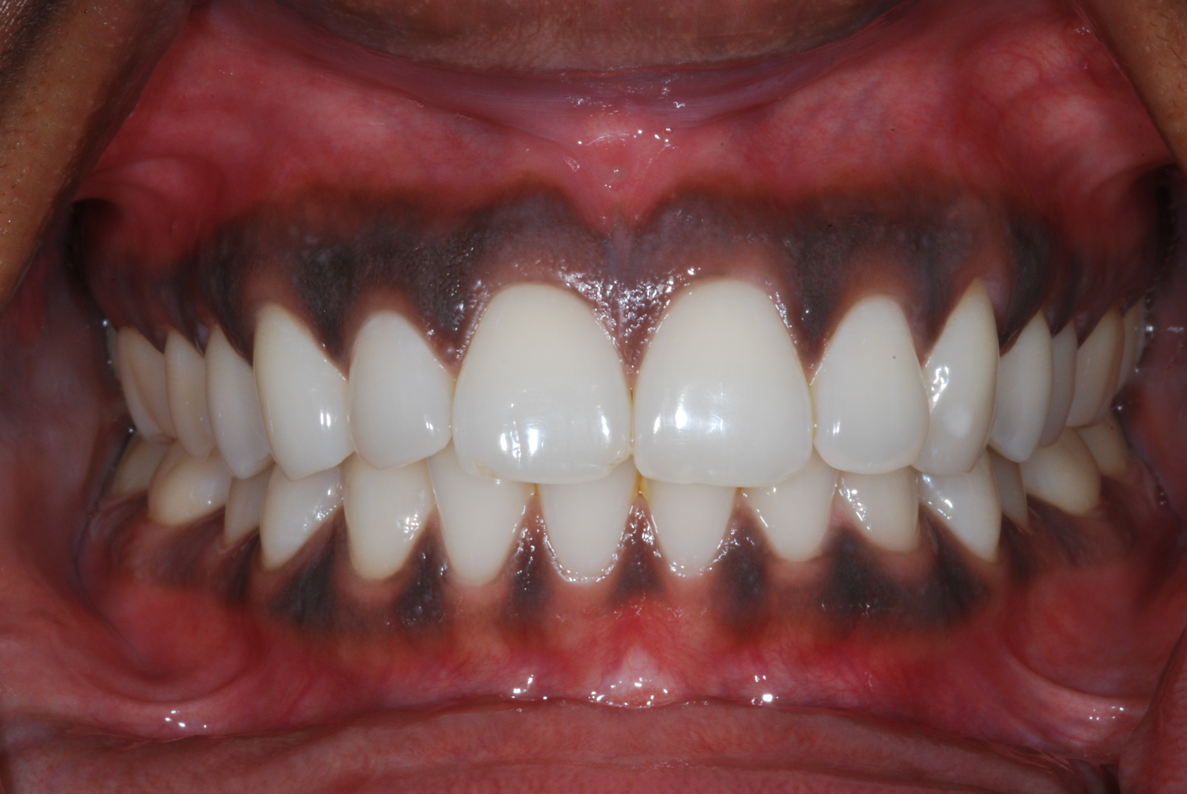 Why some people have black gums | Pulselive Kenya