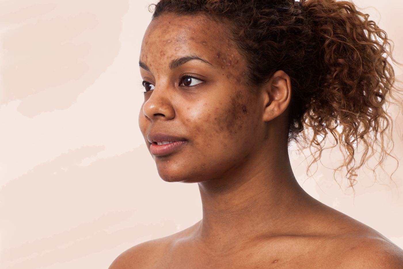 6 ultimate hacks to acne facial scars naturally