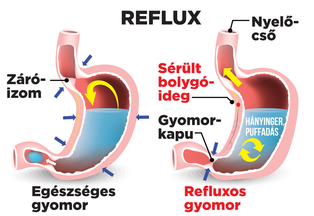 A szívinfarktushoz hasonló panaszokat is okozhat a reflux - Blikk