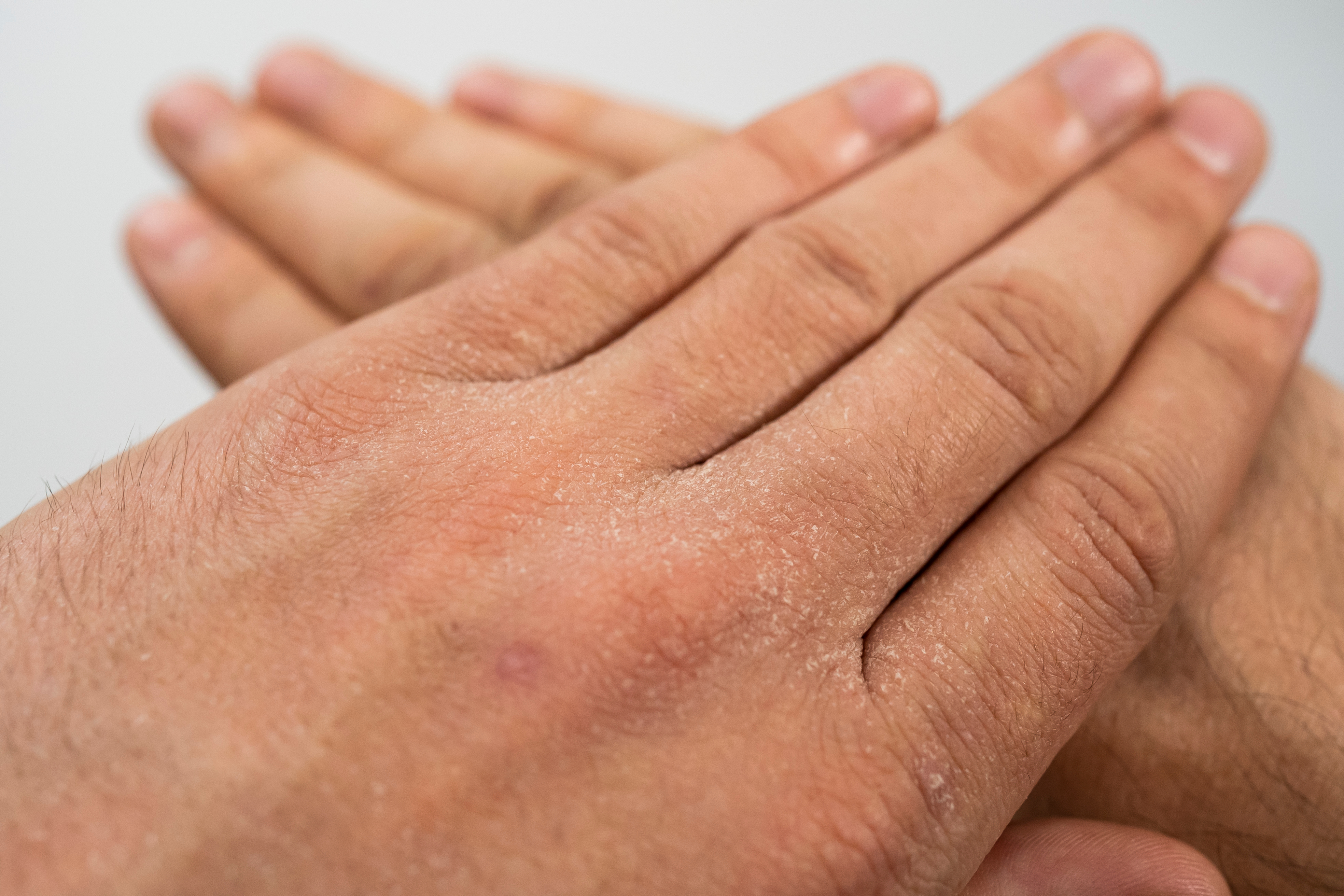 Zniszczone dłonie i problemy z cerą. Jak pielęgnować skórę w czasie  pandemii? - Kobieta