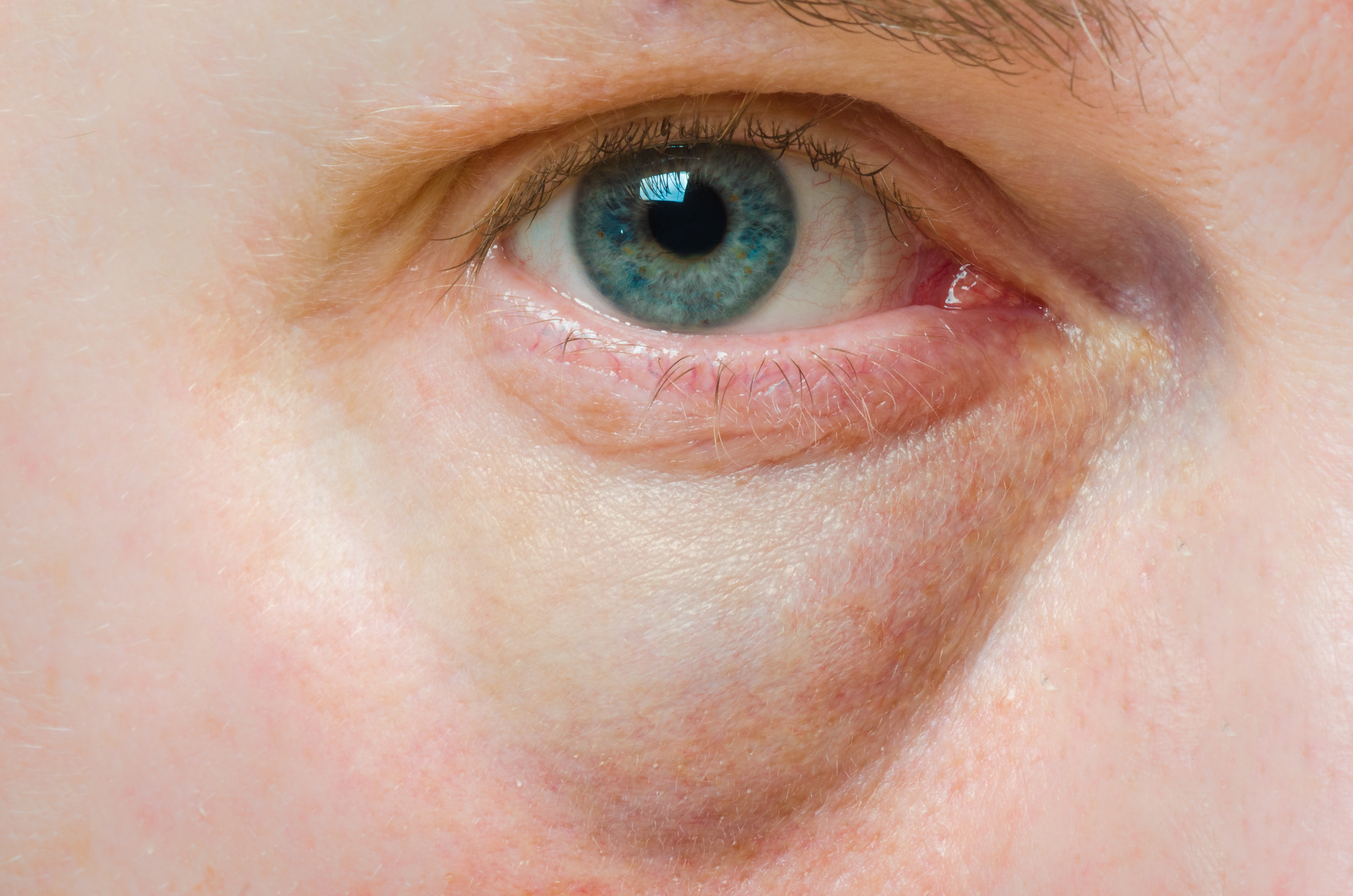Opuchnięte oczy — przyczyny. Domowe sposoby leczenia - Uroda