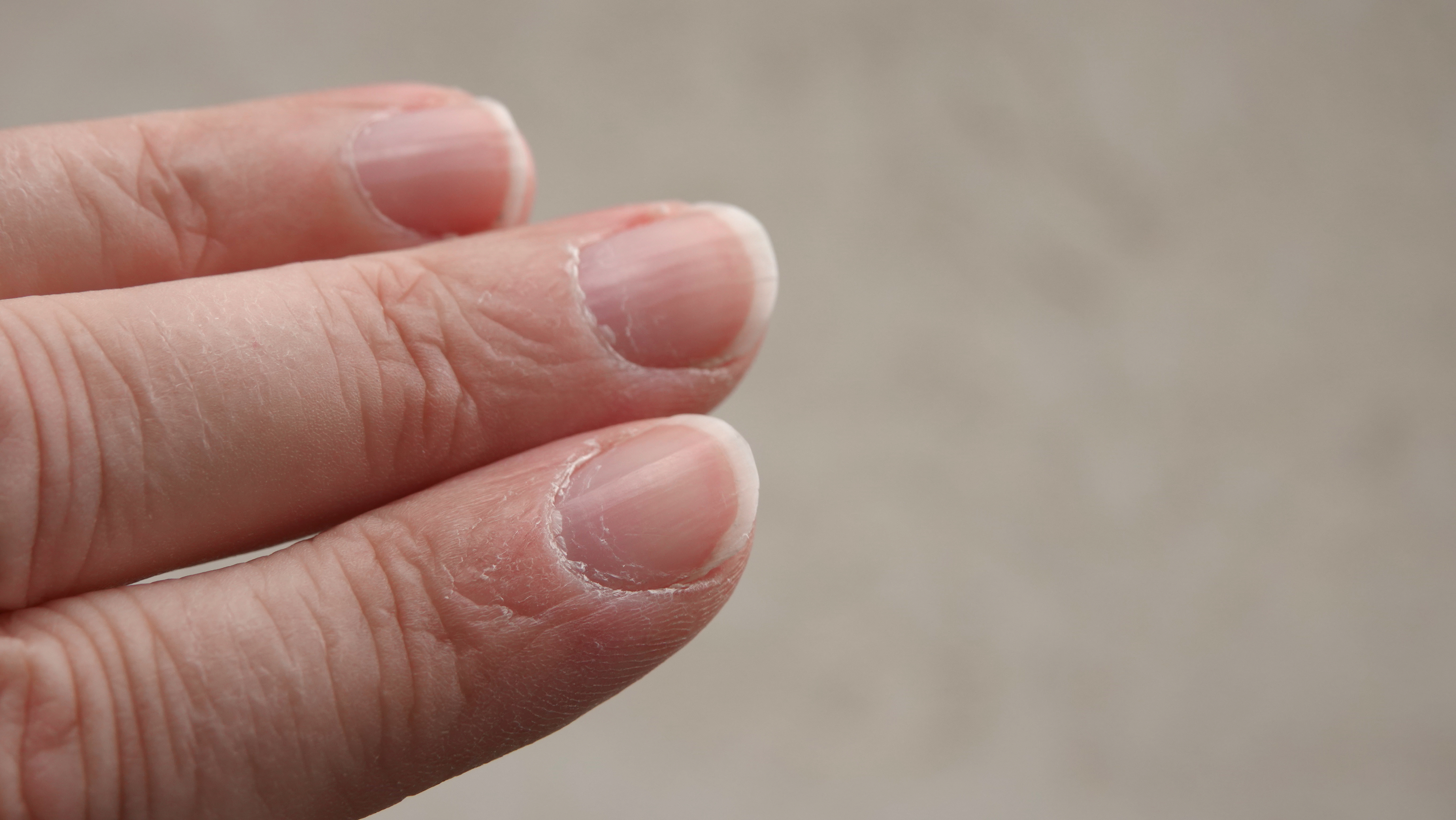Pękająca skóra przy paznokciach - przyczyny, brak witamin - Uroda