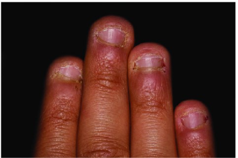 Tips on how to stop nail biting