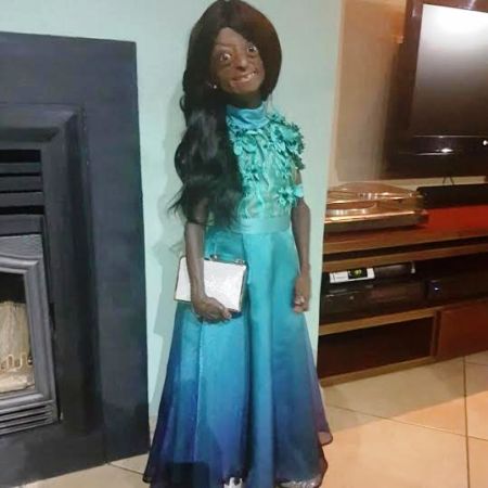 In South Africa Meet The 17 Yr Old Girl That Looks 70 Due To Rare