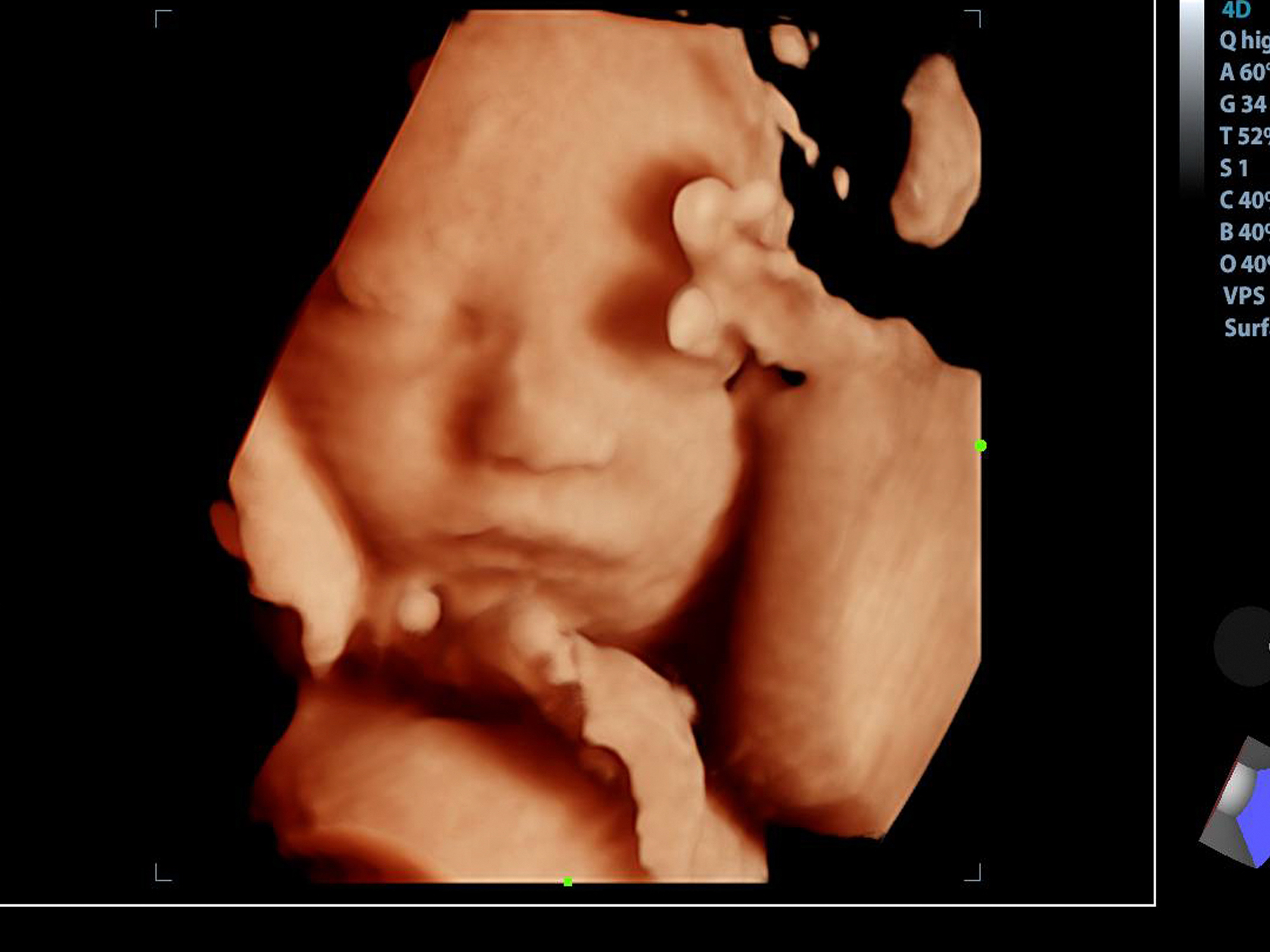 Okozhat-e gondot az ultrahang vizsgálat a babának? - Blikk