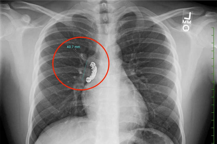 Man, 22, lands in hospital as one of grillz worn to decorate teeth gets stuck in his lungs