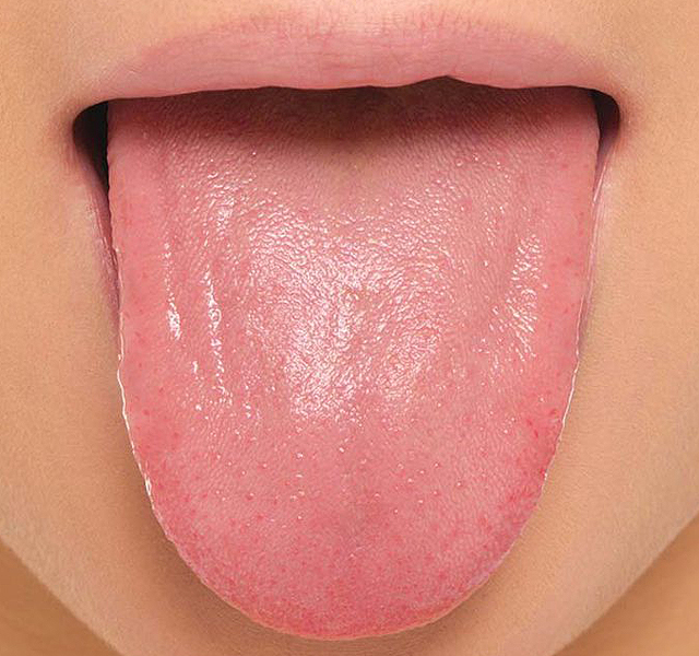 Ez a súlyos betegség fenyeget, ha ilyen elváltozásokat látsz a nyelveden -  Blikk Rúzs