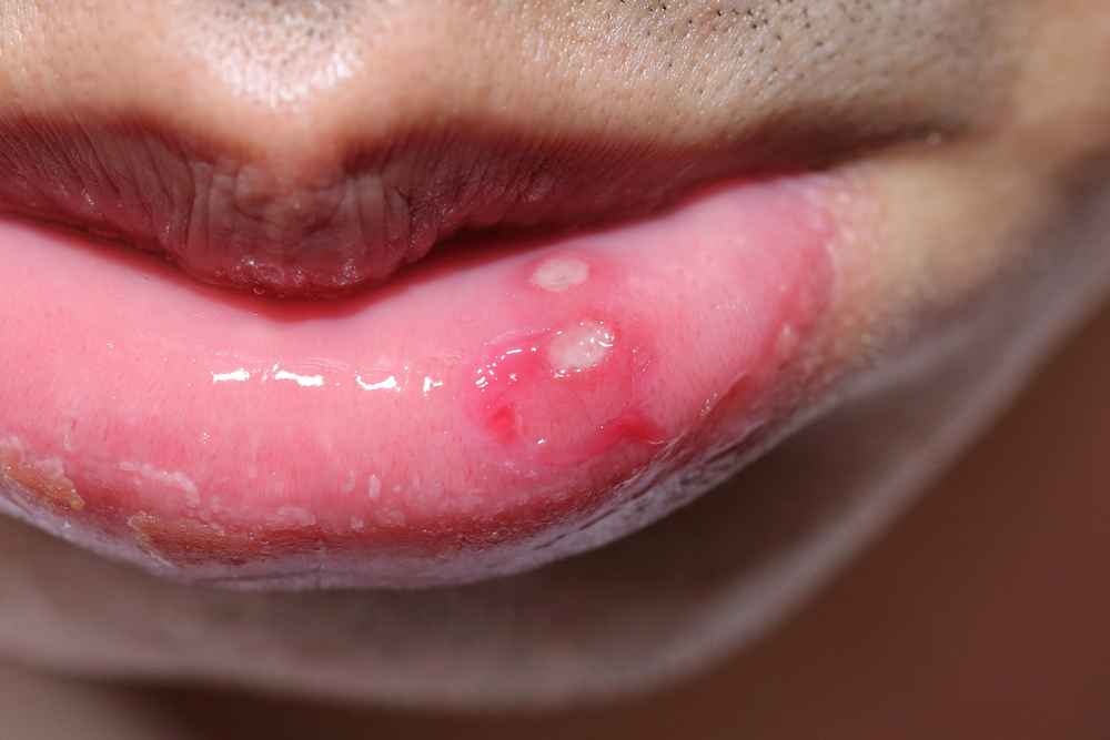 Afta na języku i w jamie ustnej - przyczyny i leczenie domowe afty - Zdrowie