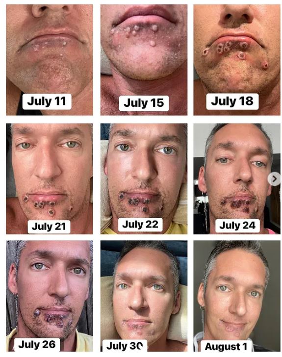 Gay porn star shares pictures of monkeypox symptoms that feel \'like knives stabbing you\'