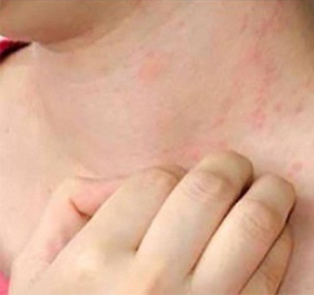 Bőrparaziták tünetei