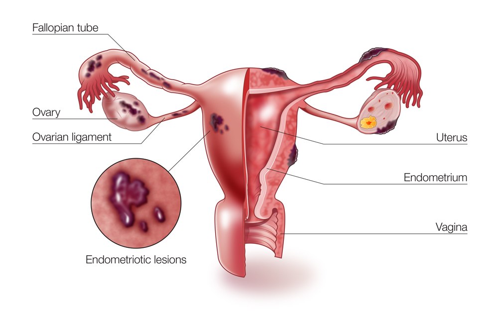 Endometriosis: Causes, symptoms, prevention and treatment