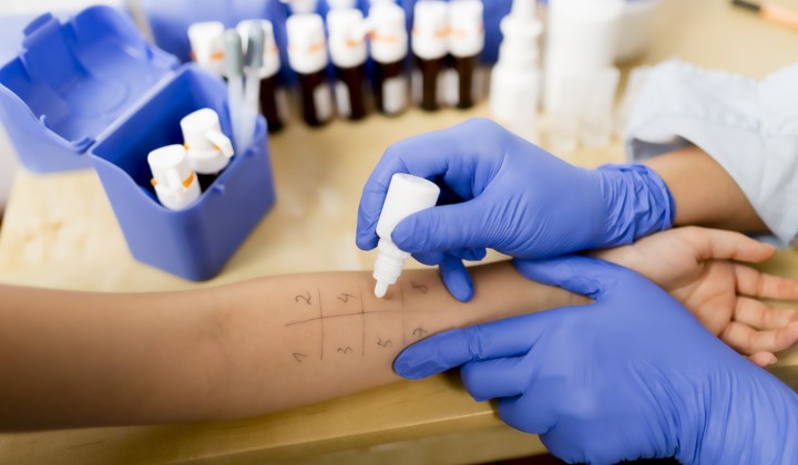 Diagnostyka alergii pokarmowej i wziewnej - skórne testy alergiczne