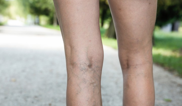 Skleroterapia – zabieg usuwania żylaków