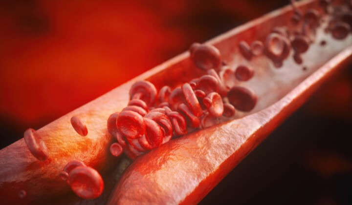 Diagnostyka miażdżycy - panel badań krwi