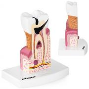 Pomoce naukowe - Physa Chory ząb - model anatomiczny PHY-TM-1 - miniaturka - grafika 1