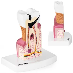 Physa Chory ząb - model anatomiczny PHY-TM-1 - Pomoce naukowe - miniaturka - grafika 1