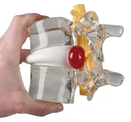 Meble i wyposażenie gabinetów medycznych - Model dyskopatii - Symulator przepukliny jądra miażdżystego Erler Zimmer - miniaturka - grafika 1