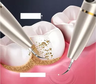 Skaler Dentystyczny z Kamerą i Latarką Ultradźwiękowy Braders - Pozostałe urządzenia kosmetyczne - miniaturka - grafika 12