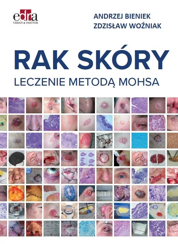 Rak skóry. Leczenie metodą Mohsa