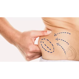 Liposukcja strzykawkowa i podstawy liposukcji sprzętowej - Vouchery - miniaturka - grafika 1