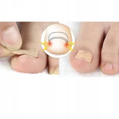 Akcesoria do paznokci - 10 x Paski wrastające paznokcie klamra plastry Hit - miniaturka - grafika 1