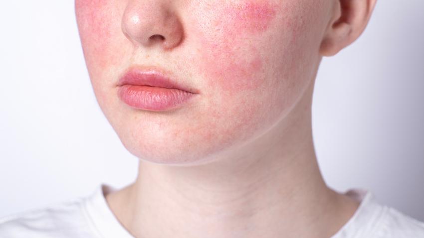 Piros erek orron, arcon rosacea