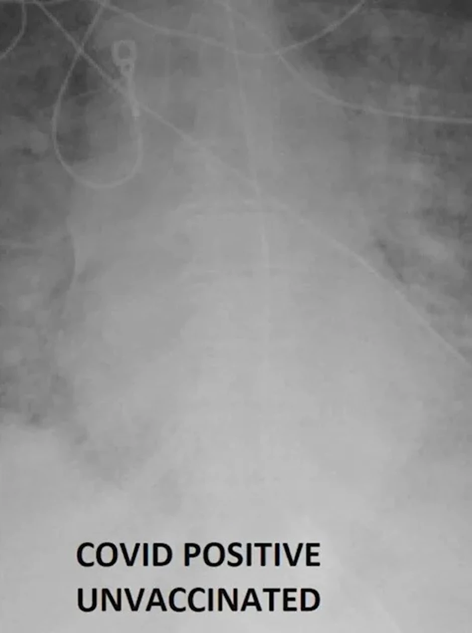 Rendgenski snimak nevakcinisanog pacijenta obolelog od kovida