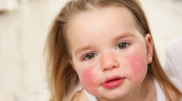 Atopowe zapalenie skóry u dzieci