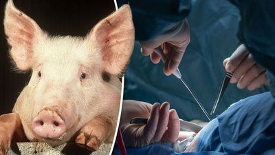 Kidney transplant done with pig's kidney [dailyexpress]